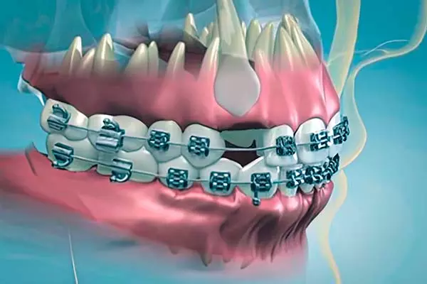 Representation of impacted canines
