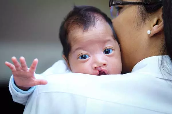  Baby with cleft lip