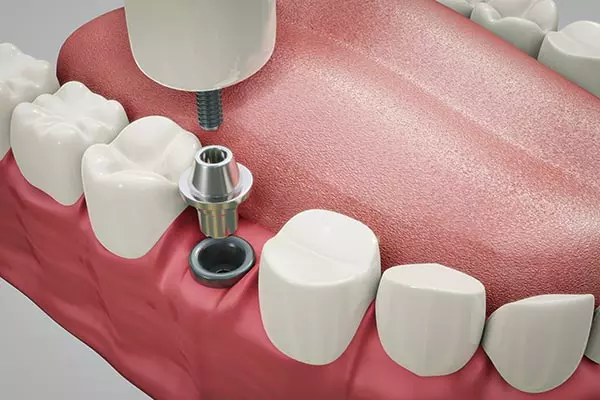 Simulation of a dental implant process